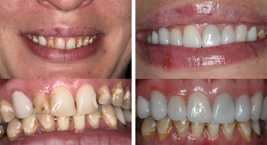 Porcelain Crowns #1