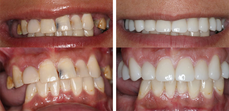 Porcelain Crowns #2