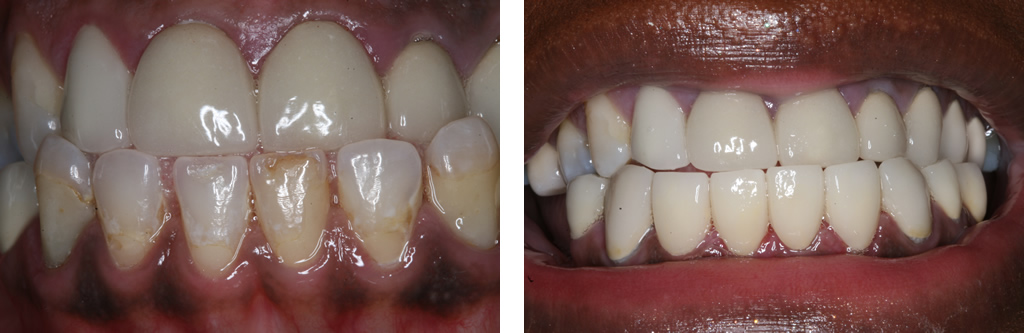 Porcelain Crowns