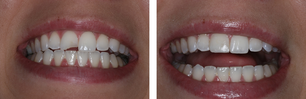 Tooth Color Filling