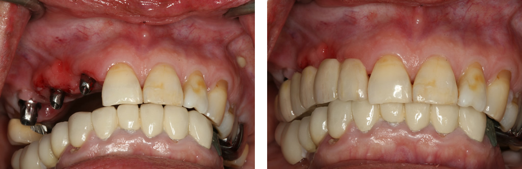 Implant Bridge