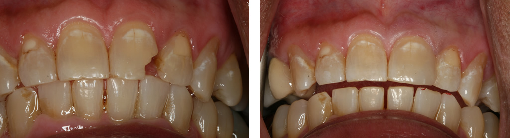 Tooth Color Filling